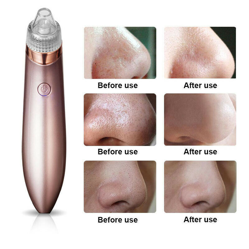 Electric Blackhead Vacuum Pore Cleaner - Acne & Pimple Remover with Strong Suction, Diamond Dermabrasion, USB Rechargeable Face Cleaner